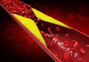 About 1 in 10 U.S. Adults Have High Cholesterol