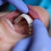 Scientists Identify Genes That Shape People’s Teeth